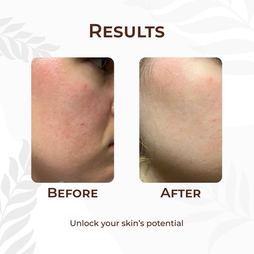AcARRE Beauty Edit, Luxurious Multi-Use Treatment Oil, Baobab & Kalahari Melon Oil for Skin & Hair Rejuvenation, Eczema Relief, and Scalp Revitalization - 0.5 fl oz