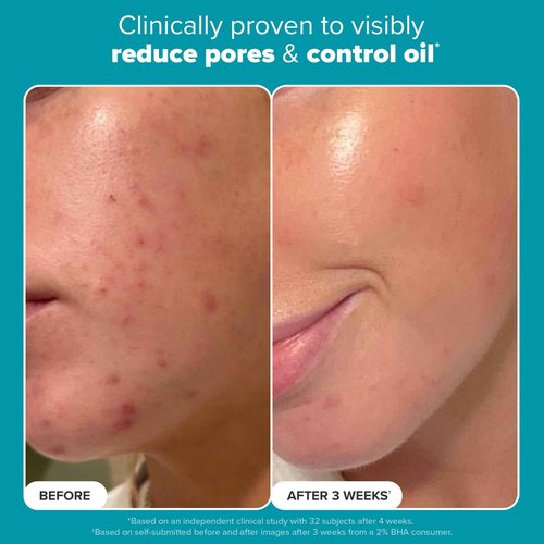 Paula's Choice SKIN PERFECTING 2% BHA Liquid Salicylic Acid Exfoliant-Facial Exfoliant for Enlarged Pores, Wrinkles & Fine Lines, Suitable for Blackhead-Prone Skin, Fragrance-Free