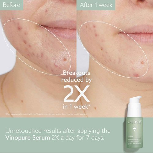 Caudalie Vinopure Acne-Prone Essentials Skin Care Set with Full-Size Vinopure Serum + 2 Free Travel-Size Products ($66 Value)