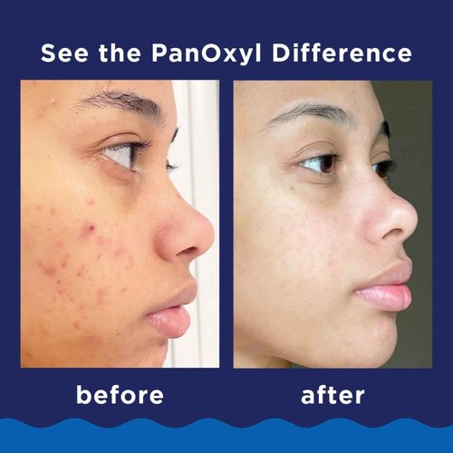 PanOxyl Foaming Acne Wash Maximum Strength 5.5 oz (Pack of 6)