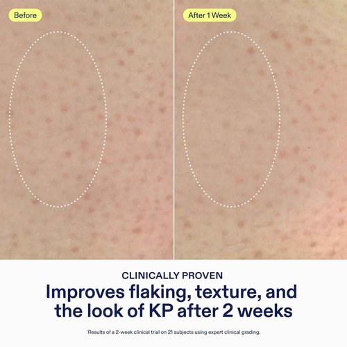 Skinfix KP + PsO Smoothing Body Treatment - 5.07 oz - Clinical-Grade Lactic Acid Smoothing Treatment for Keratosis Pilaris- and Psoriasis-Prone Skin - Safe for Sensitive Skin - Vegan, Cruelty Free