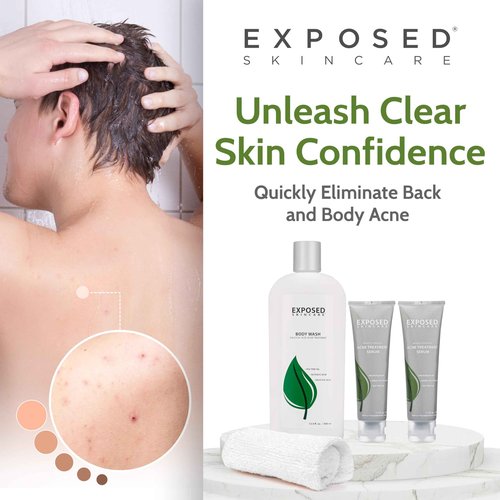 Exposed Skin Care, Body Acne Kit with 3.5% Benzoyl Peroxide and 0.5% Salicylic Acid to Clear Up Teen and Adult Bacne and Body Acne – Natural, Non-toxic and Cruelty Free