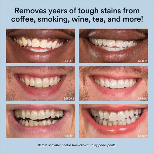 Auraglow Teeth Whitening Kit & Extra Strength Whitening Pen