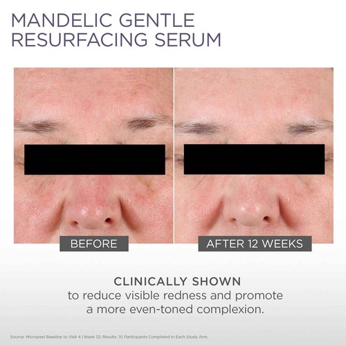 Glytone Micro-Peel 10% Mandelic Acid Serum | Anti-Aging AHA Gentle Exfoliant with Phytic Acid for all Skin types | Reduces Redness, Uneven tone & Dark Spots | Fragrance-Free, Paraben-Free - 1 Fl oz.
